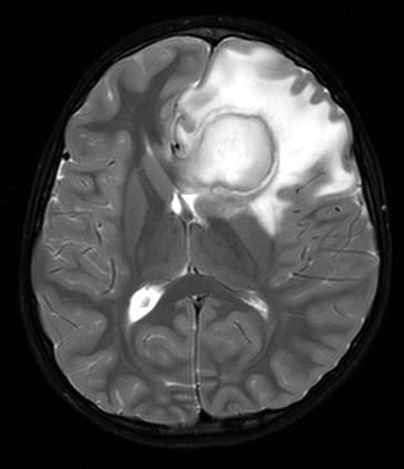 smadzeņu abscess 