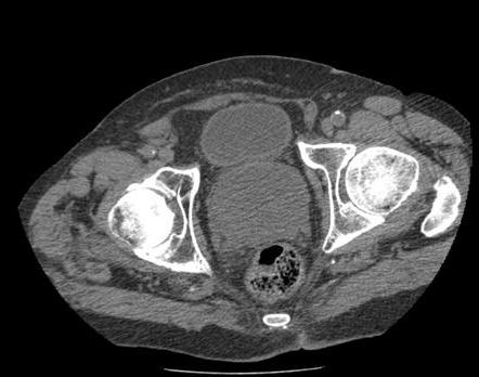 Prostatas adenoma vīriešiem: etioloģija, klīnika un diagnostikas metodes