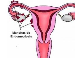 endometriozes un adenomiozes atšķirības