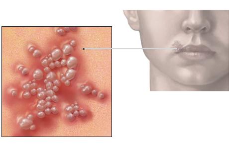 Interesanti ir zināt, kas ir herpes