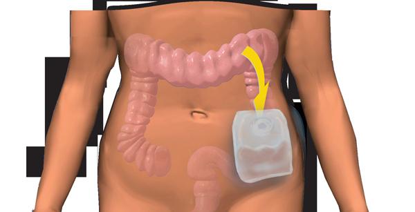 Kolostoma - kas tas ir? Kolostomija: pēcoperācijas aprūpe