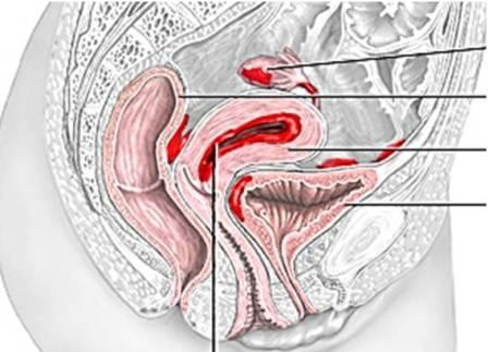 dzemdes endometriozes tautas ārstēšana