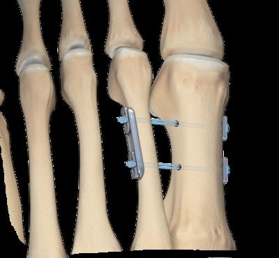 Ķemmes kakla ārstēšana uz īkšķa kājām bez operācijas