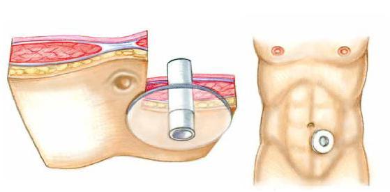 Stoma zarnās